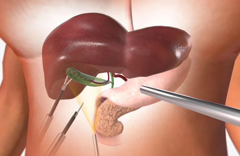 Which Size of Gallbladder Stone Is Dangerous
