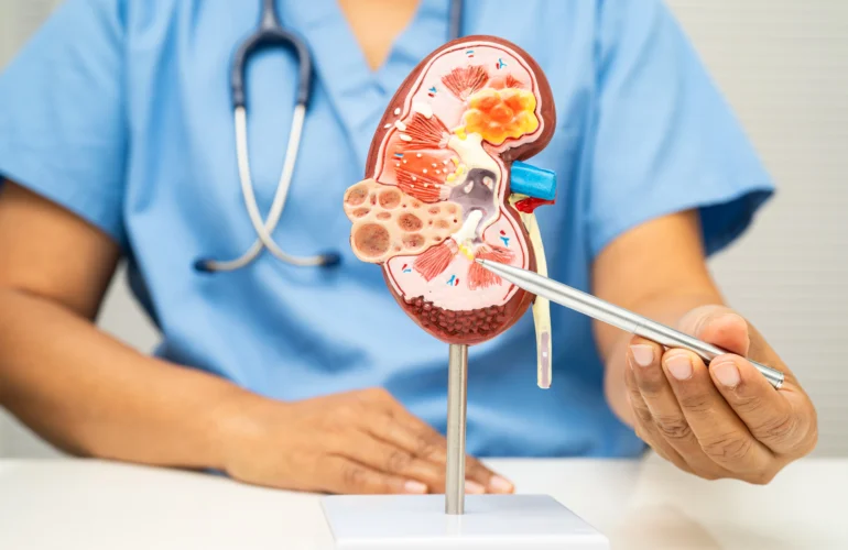 what are the first signs of kidney stones